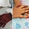 Image result for hand transplant