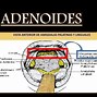 Image result for adenoided