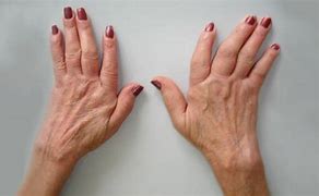 Image result for artritis