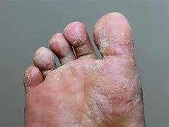 Image result for Parasites On Feet