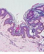 Image result for acnicoria