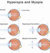 Image result for Myopia Drawing