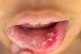 Image result for Small Quamous Papilloma Tongue