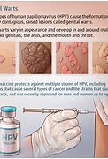 Image result for Genital Wart or Acne