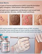 Image result for Warts On Genital Area Male