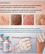 Image result for genital warts cause