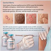 Image result for Genital Diseases