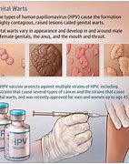 Image result for Genital Warts Skin Tags