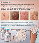 Image result for Genital Wart Stalk