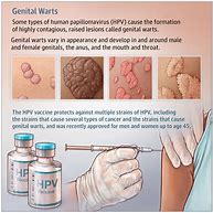 Image result for Genital Wart Lesion Type