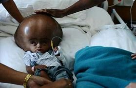 Image result for Baby Big Head Syndrome