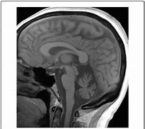 Image result for Brain Shrinking Disease Symptoms