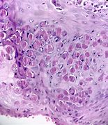 Image result for Molluscum Bodies Histology