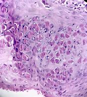 Image result for Molluscum Pathology