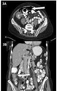 Image result for Annular Lesion Colon