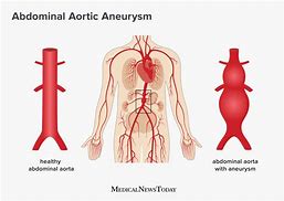 Image result for Abdominal Aortic Aneurysm Heart Beat