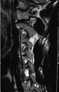 Image result for Cervical Spine C5 C6 Symptoms