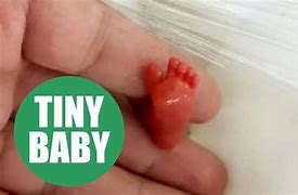 Image result for World's Smallest Baby in the UK