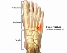 Image result for 5th Metatarsal Jones Fracture Foot