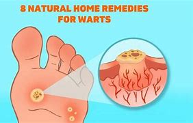 Image result for Remove Warts On Face