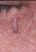 Image result for Filiform Wart or Skin Tag