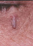Image result for Filiform Wart or Skin Tag