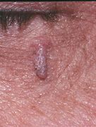 Image result for Filiform Warts Treatment