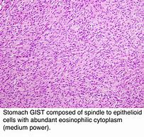 Image result for Gist Tumor