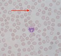 Image result for Sickle Cell Anemia Blood Smear