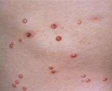 Image result for Molluscum Contagiosum Treatment Bakersfield