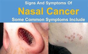 Image result for Nasal Polyps Cancer Symptoms