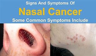 Image result for Nasel Cavity Cancer