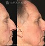 Image result for Actinic Keratosis Treatment On Face