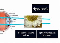 Image result for hiopsia