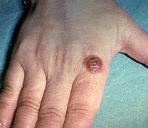 Image result for ORF Skin Lesion