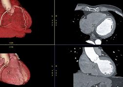 Image result for Angiogram Pictures