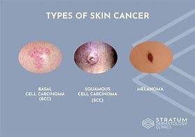 Image result for Looks Like Wart Skin Cancer