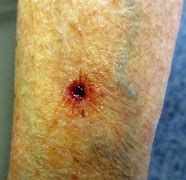 Image result for Pea Size Lump Under Skin