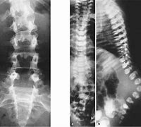 Image result for Spina Bifida Posterior Rachischisis