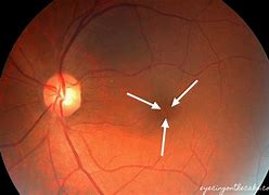Image result for Vision with Macular Hole Patients
