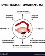 Image result for Ovarian Cyst Rupture Symptoms