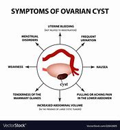 Image result for Ovarian Cyst Symptoms in Women