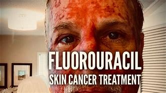 Image result for Fluorouracil Topical Cream Erosion Stage