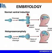 Image result for Holoprosencephaly Schematic/Diagram