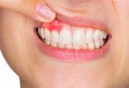 Image result for Abscess Tooth Gum Infection