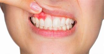 Image result for Gingival Abscess
