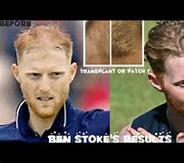 Image result for Ben Stokes Before After Hair Transplant