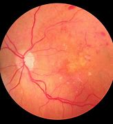 Image result for Central Retinal Vein Occlusion