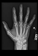 Image result for Extra Pinky Finger