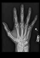 Image result for Deformed Pinky Finger